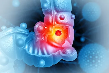 تحدث بدون ألم- 5 علامات تخبرك بأنك مريض سرطان قولون
