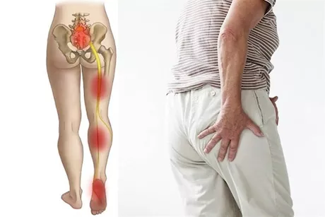 لمرضى عرق النسا- طبيب يوضح الأطعمة الممنوعة والمسموحة