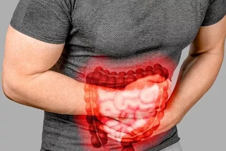 5 أخطاء تؤدي إلى تفاقم أعراض التهاب القولون التقرحي.. تجنبها