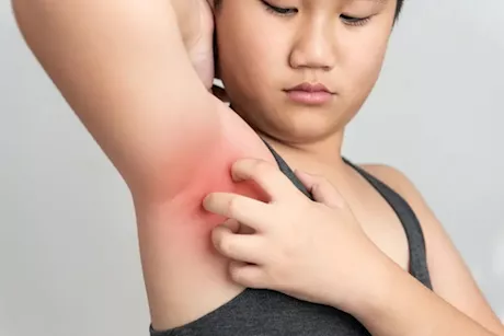 أسباب طفح الإبط- احذر من علاماته