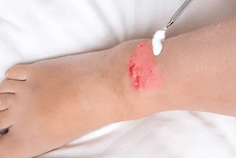 جروح القدمين.. متى تدل على مشاكل خطيرة بالأوعية الدموية؟