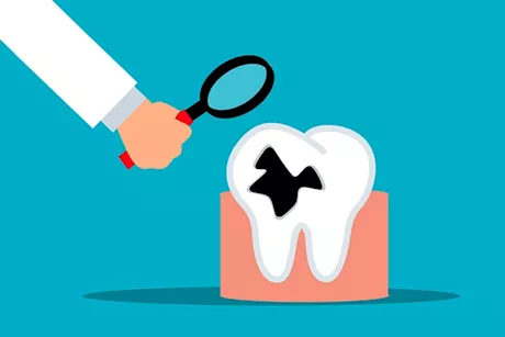 تسوس الأسنان بدون سكر- 6 أشياء قد تكون السبب