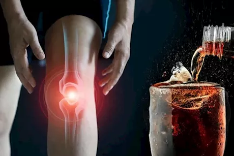 ماذا يحدث لعظامك عند تناول المشروبات الغازية يوميًا؟