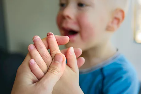 نقص الفيتامينات عند الأطفال- علامات تظهر على الأظافر