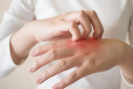 حكة اليد المتكررة.. تعرف على الأسباب وطرق العلاج والوقاية