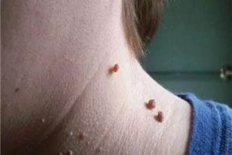 طريقة طبيعية للتخلص من الزوائد الجلدية المزعجة