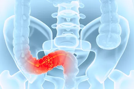 الوقاية من سرطان القولون- ابدأ يومك بهذه الأطعمة لحماية نفسك