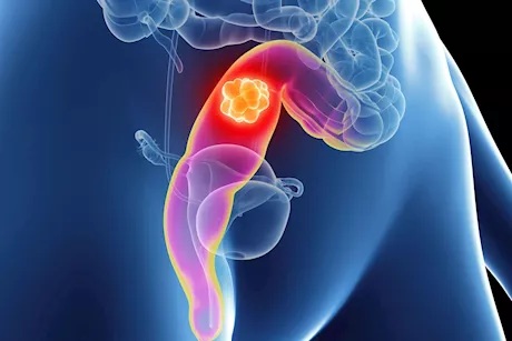 سرطان القولون بعد الثلاثين- 5 أعراض لا تتجاهلها