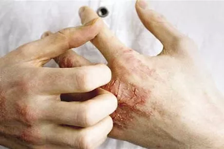 هذه فوائد بذور الحلبة لعلاج الإكزيما- إليك طريقة استخدامها