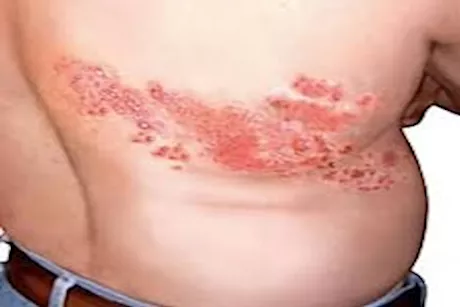 هؤلاء أكثر عرضة للإصابة بالحزام الناري.. طبيب يوضح