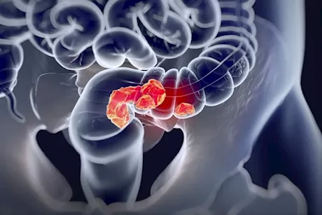 أعراض سرطان القولون عند الشباب- 6 علامات احذرها