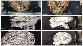 فريق طبي بمستشفى دكرنس العام ينقذ طفلًا من تهشم كامل بالوجه -صور