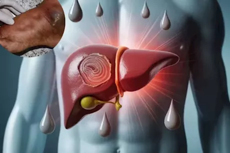 أعراض ضعف وظائف الكبد- 7 علامات تظهر على القدمين