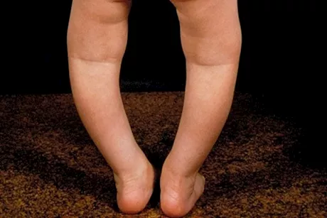 5 نصائح فعالة تحمي طفلك من الكساح