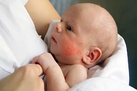 لدغات البعوض للأطفال.. ما أفضل طريقة لعلاجها؟