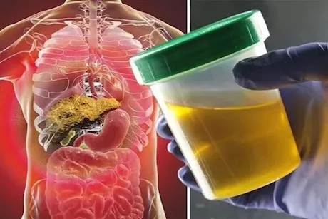 متى تقلق من لون البول؟ – طبيب يجيب