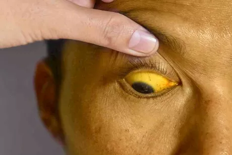 اصفرار الجلد الخفيف- متى يكون مؤشرًا على مشكلة في الكبد؟