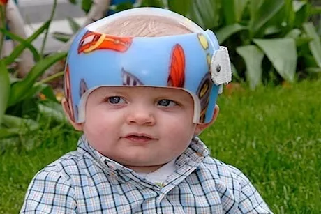 كبر حجم رأس الطفل بعد الولادة.. هل تدعو للقلق؟