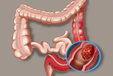 أعراض سرطان القولون بالصور- 6 علامات احذرها