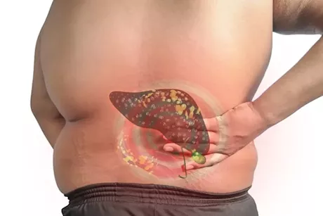 ألم الكبد الدهني- 4 أماكن بجسمك يحدث فيها