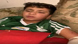 أكل قطع من ذراعه.. "آدم" ضحية جديدة في مسلسل رعب الكلاب ببورسعيد