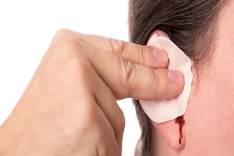 نزيف الأذن.. إسعافات أولية لتجنب فقدان السمع