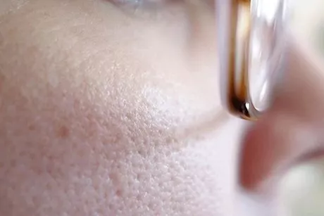 علاج مسام الوجه- 5 نصائح لتضييقها