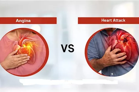 النوبة القلبية والذبحة الصدرية- جمال شعبان يوضح الفرق بينهما "فيديو"
