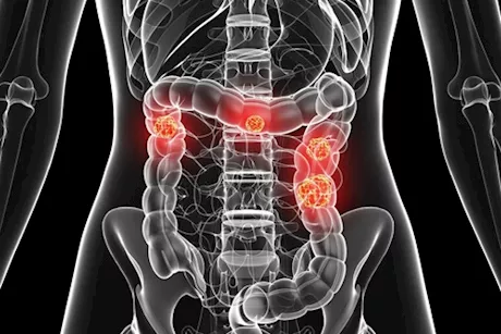سرطان القولون المنتشر- ماذا يحدث إذا وصل إلى العظام؟