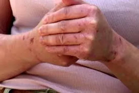 ملح إبسوم.. هل يساعد على تهدئة الإكزيما؟