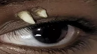 استخراج سن من تجويف عين مراهق هندي 