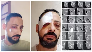 استغاثة مواطن بالغربية بعد الاعتداء عليه: "ركبت شرايح ومسامير" (صور)