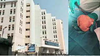 عمرها عام ونصف.. أطباء معهد الكبد بالمنوفية يستخرجون تكويناً جنينياً من معدة رضيعة