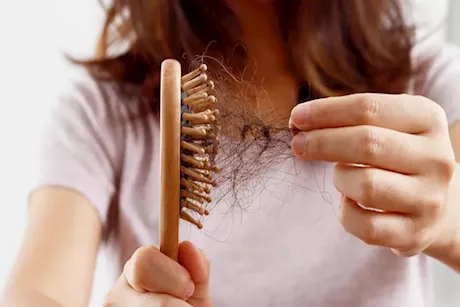 تساقط الشعر بعد حمى الضنك.. طبيبة توضح الأسباب وطرق التعامل