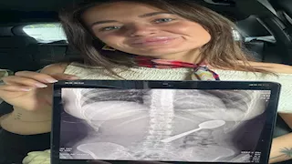 قفزة كلب تنتهي بكارثة.. امرأة بلجيكية تبتلع ملعقة طولها 17 سم