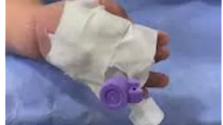 أول رد من صحة القليوبية على إصابة رضيع بشلل رباعي بسبب تركيب "كانيولا"