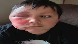 "تحدي تيك توك" يتحول لكارثة.. طفل يصاب بحروق خطيرة 