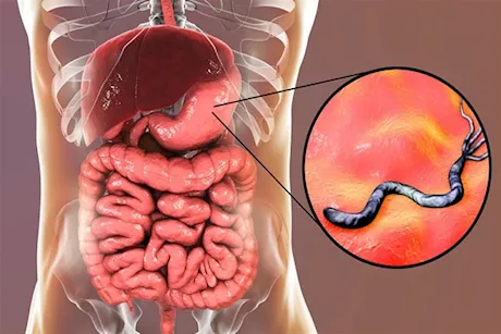 جرثومة المعدة- هل تسبب مخاط في البراز؟