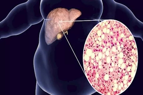 الكبد الدهني.. أخطاء غذائية تفاقم أعراضه