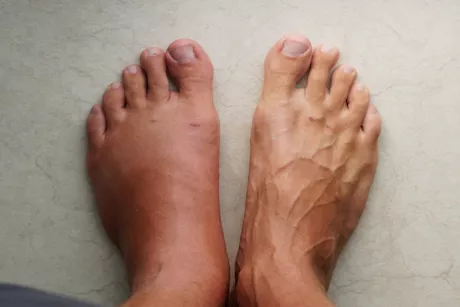 تورم القدمين في رمضان- طبيب يوضح السبب