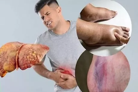 الكبد الدهني.. علامات ليلية تشير إلى الإصابة به 