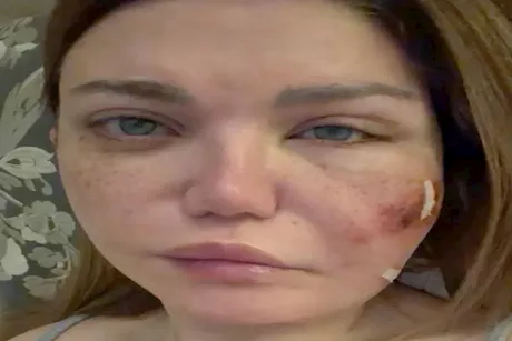 بعد إصابة ياسمين الخطيب.. علامات العدوى البكتيرية في الجلد وطرق علاجها