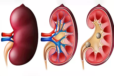 ما المراحل الـ5 لمرض الكلى المزمن؟.. تعرّف على تأثيراته وكيفية الوقاية