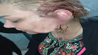 قطع بالوجه وإصلاح العصب السابع.. التقرير الطبي في واقعة ضحية طليقها بالسيدة زينب  