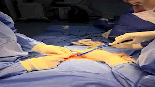  نجاح جراحة دقيقة لمولود وُلد بدون فتحة شرج في الدقهلية