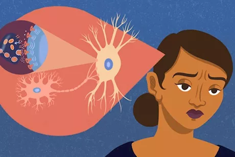 ما هو تأثير الاكتئاب على الأعصاب؟- طبيب يجيب "فيديو"