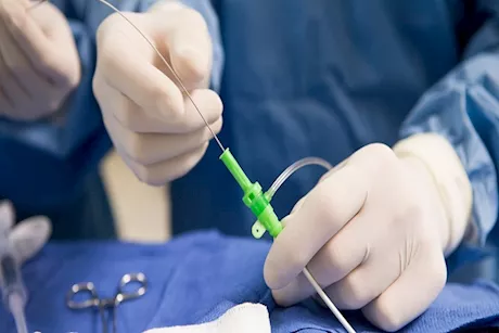 مريض القلب.. هل يعود لطبيعته بعد تركيب الدعامة؟