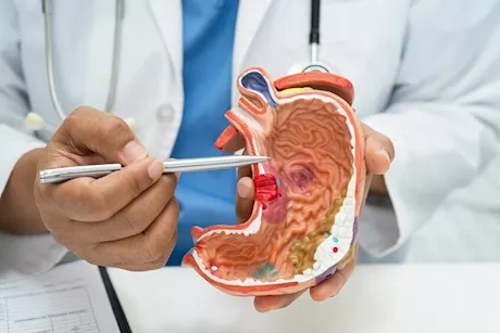 قرحة المعدة.. هل تسبب فقر الدم؟