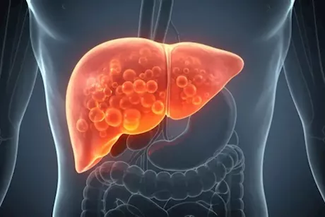  الدهون على الكبد- إليك أعراضها والفحوصات اللازمة لاكتشافها