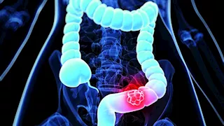 تدمر العظام والقولون.. أطعمة احذر الإفراط فيها آخر أيام رمضان